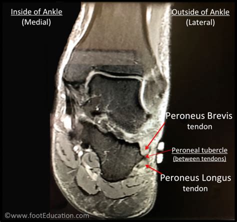 ► shoulder ► elbow ► wrist ► finger ► thumb. Peroneal Tendonitis - FootEducation