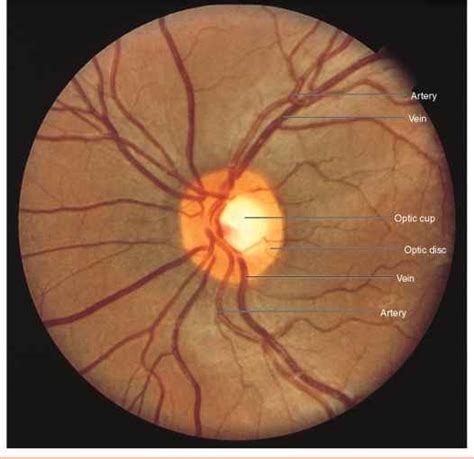 Normal Optic Disc Physical Diagnosis Mitch Medical