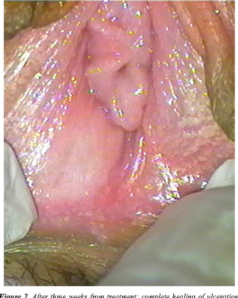 Figure From Unusual Multiple Recurrence Of Lipsch Tz Ulcer Of The