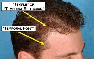 Only 1mg Finasteride To Maintain The Current Density R Tressless