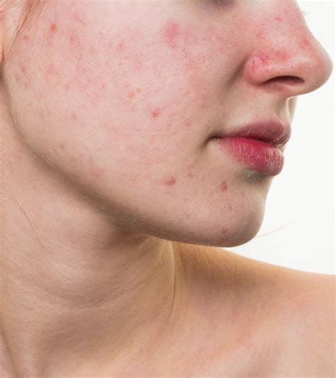 Papier Tumeur Maligne Compétitif Red Spots On Face A Gagné Tempérer