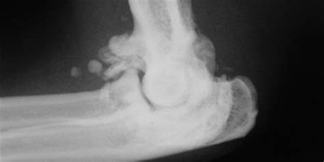 arthrosis arthrosis kezelése az ágyéki láb osteochondrosisa