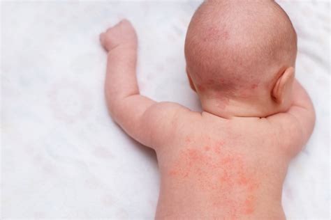 Dermatite Da Sudore Del Neonato Come Trattare La Pelle Farmacia Bottasso