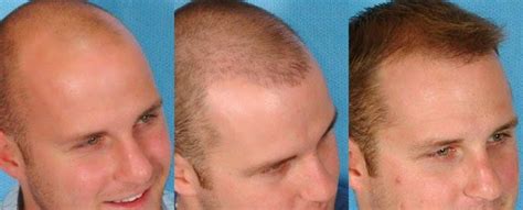 Follicular Unit Transplantation Fut Is A Hair Restoration Technique