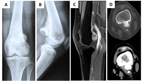 Image Features Of Chondrosarcoma In The Metaphysis Of The Distal Femur Download Scientific