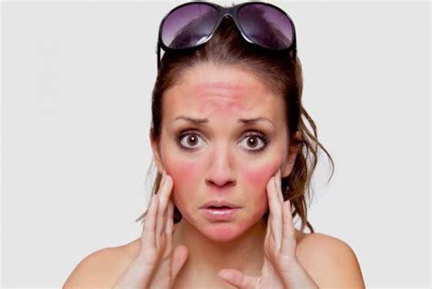 Home Remedies For Sunburn On Face Itchy Severe And With Blisters