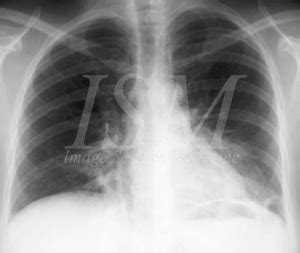En cas de doute diagnostique, l'angioscanner thoracique permet d'éliminer l'embolie pulmonaire. Bienvenue sur le site d'ISM