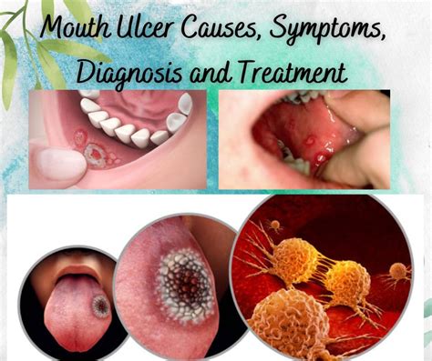 Understanding Mouth Ulcer And Treatment Healthy Life With Dr Shaista