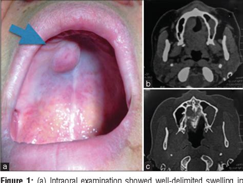Surgical Management Of Palatal Pleomorphic Adenoma Ppa Recurrence