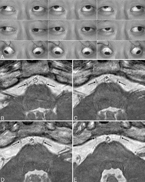 Abducens Nerve Is Present In Patients With Type 2 Duanes Retraction Syndrome Ophthalmology
