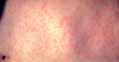 What Does A Measles Rash Look Like Heres What Parents Should Look Out For