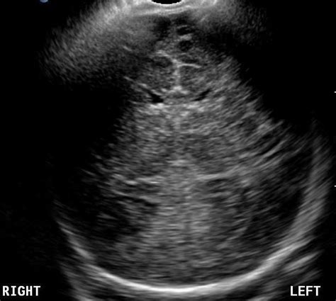Neonatal Head Normal Posterior Coronal Ultrasound Neonatal