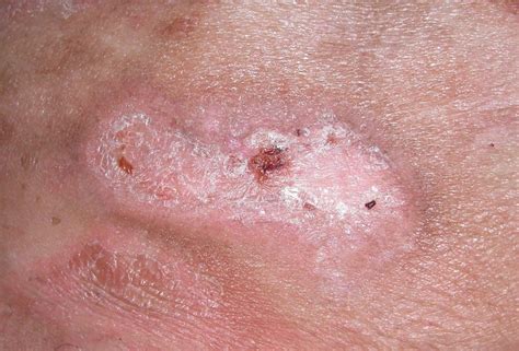 Cutaneous Lymphoma Pictures Photos