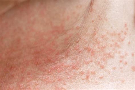 How To Prevent Treat And Identify Heat Rash Survival World