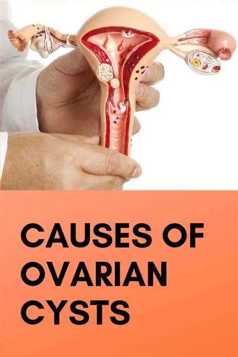 causes of ovarian cysts health experts ovarian cysts