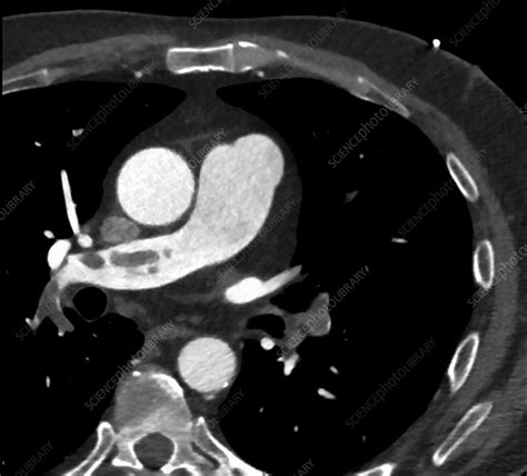 Pulmonary Thromboembolism Ct Angiogram Stock Image C0366397