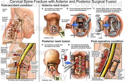 What Is The Cost Of Anterior Cervical Discectomy And Fusion Acdf