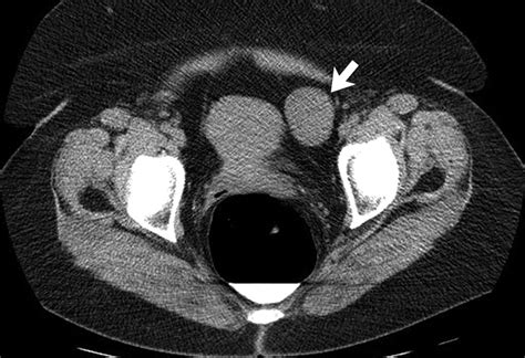 Incidental Adnexal Masses Detected At Low Dose Unenhanced Ct In