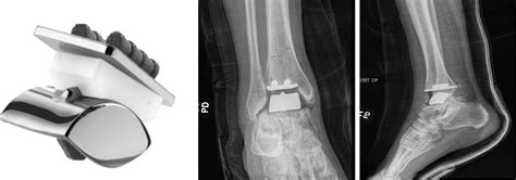 Total Ankle Replacement Options Clinics In Podiatric Medicine And Surgery