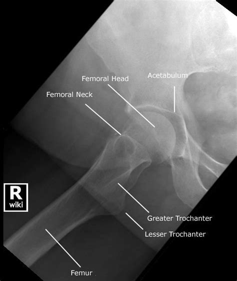 Radiographic Anatomy - Hip - Lateral Rolled Check more at http