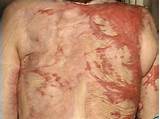Treatment For Scar Tissue After Back Surgery Images