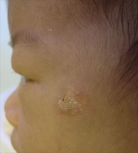 Congenital Microcystic Adnexal Carcinoma Dermatology Jama