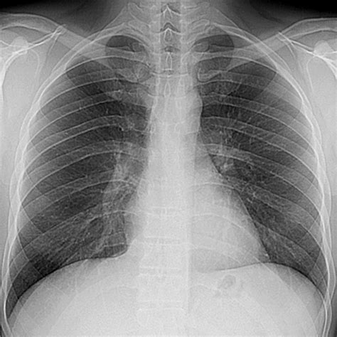 Normal Pa Chest Radiograph Of