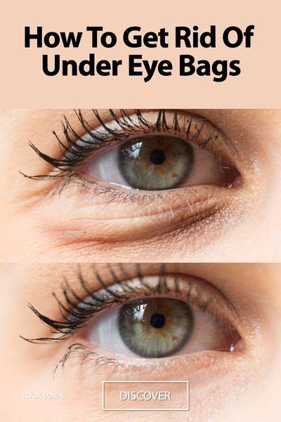 Coconut oil also contains essential fatty acids that help heal skin faster. How To Get Rid Of Under Eye Bags: The Best 10 Tips in 2020 ...