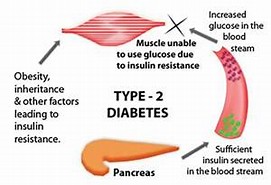 Image result for diabetes type 2