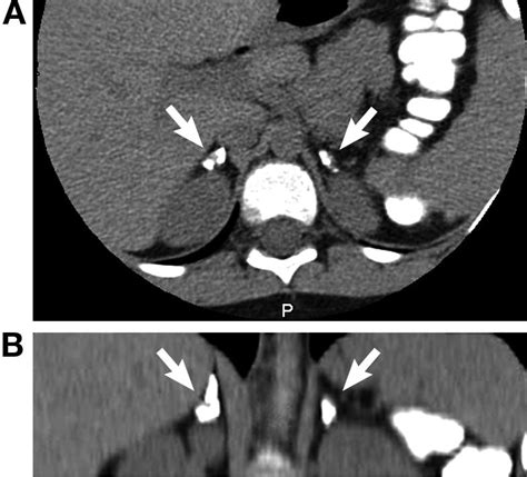 Bilateral Adrenal Calcifications On Axial A And Coronal B Images Of