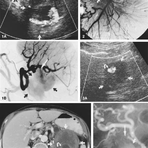 Case 2 Superior Mesenteric Angiogram Demonstrating Extravasation Of