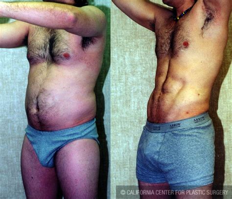 Patient Male Liposuction Abdomen Before And After Photos Encino