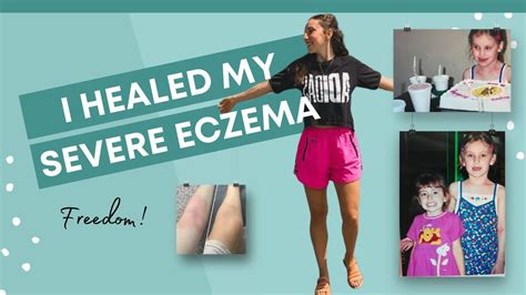 My Eczema Healing Journey Candida Stress Red Itchy Skin Youtube