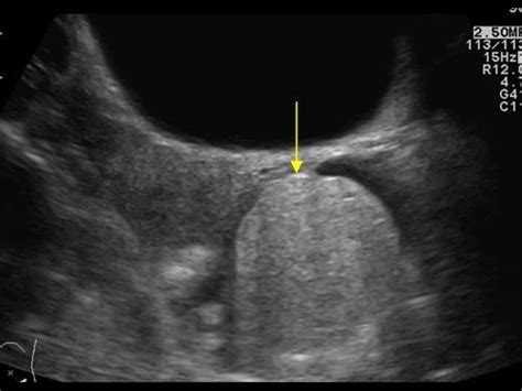 Gynaecology 32 Adnexa Case 322 Dermoid Cysts Cystic Teratomas