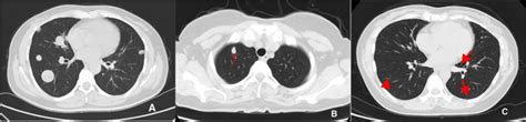 Chest Computed Tomography Ct Showed Pulmonary Benign Metastasizing