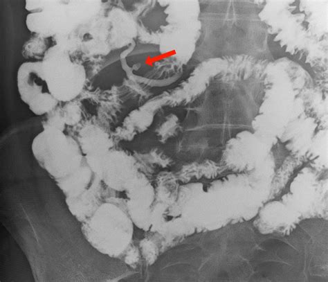 Ileocecal Appendix Diverticulum A Rare Diagnosis Eurorad
