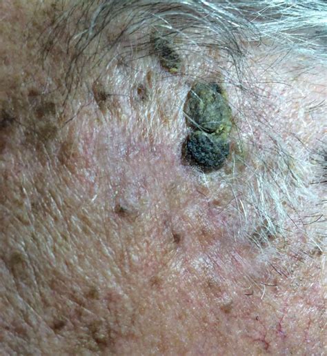 Age Wart On Face Marsden Skin Cancer Clinic
