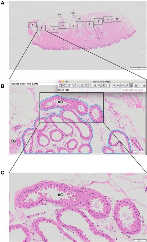 Sweat Gland Morphology In Bromhidrosis Patients A In The Sweat Gland