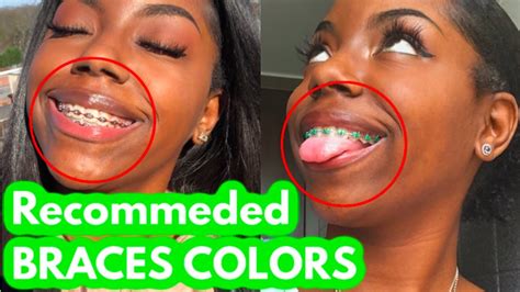 Choose These Colors On Your Next Braces Appointment Youtube