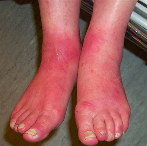 Erythromelalgia Disorder Affecting Skin Of Hand And Feet Dream Health