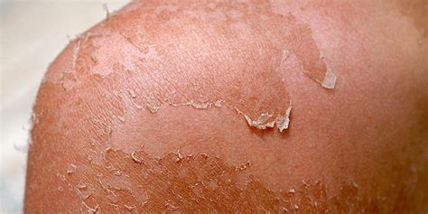 How To Safely Stop Sunburn Peeling And The Best Ways To Avoid Getting