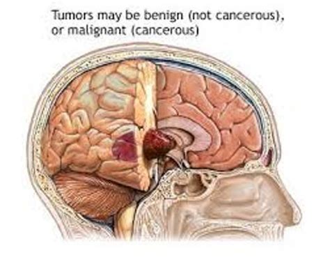 10 Facts About Brain Tumors Fact File