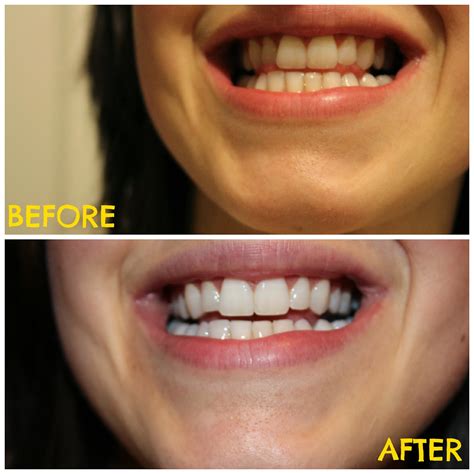 Fortunately, there is one common household product that can do wonders for teeth whitening its baking soda! The Primitive Homemaker: DIY Tooth Whitening Paste (Before ...
