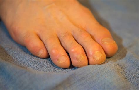 Current Concepts In Treating Acute And Chronic Toenail Injuries In Runners