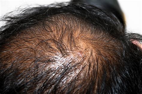 What Causes Oily Scalp And How To Treat It At Home