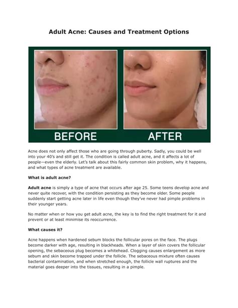 Ppt Adult Acne Causes And Treatment Options Dmkskincare Powerpoint