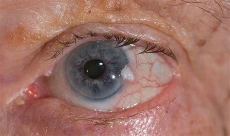 Eye Cancer Symptoms Warning Signs Of The Deadly Disease Including