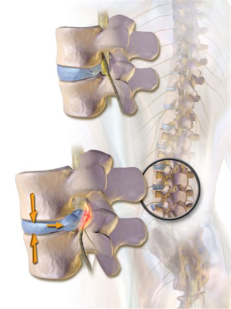 Can A Bulging Herniated Disc Heal On Its Own