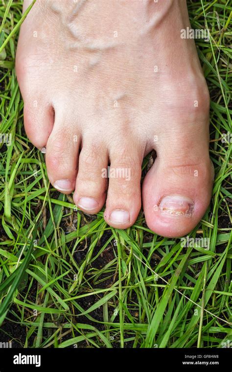 Bruised Toe Hi Res Stock Photography And Images Alamy