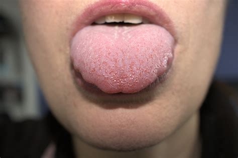 Swollen Tongue Causes What Does A Swollen Tongue Mean Lupon Gov Ph